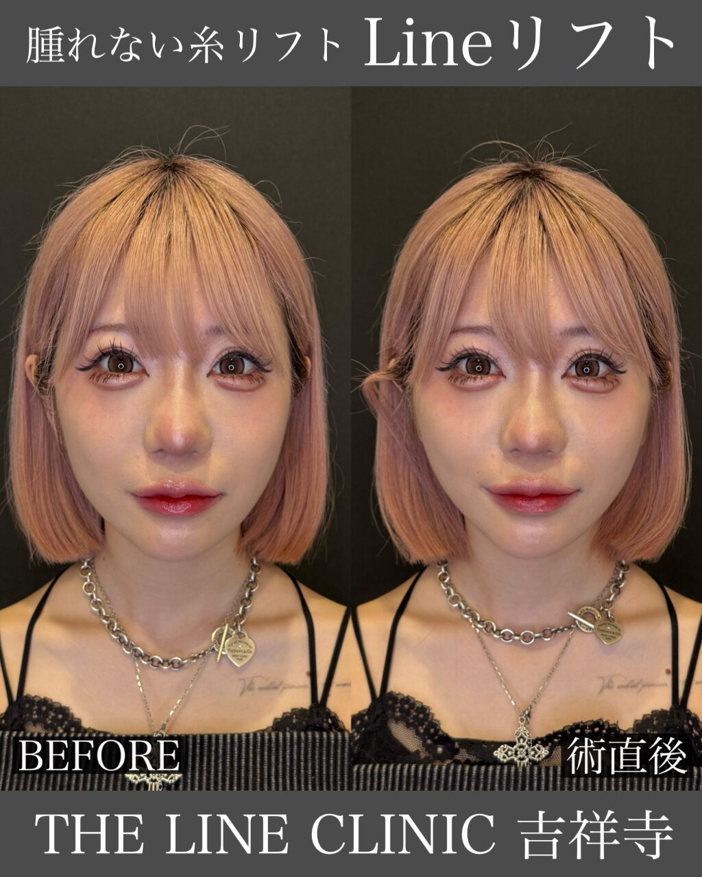 Lineリフト症例