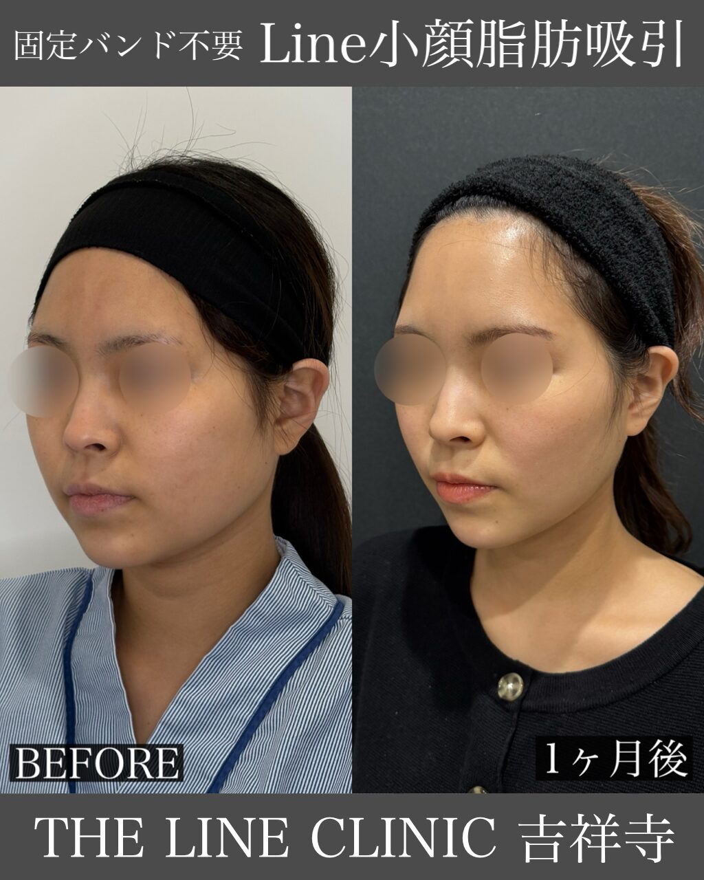 Line小顔脂肪吸引症例