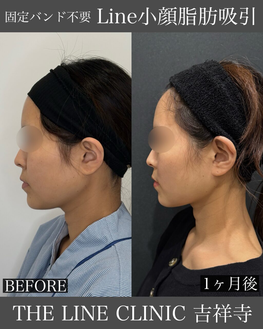 Line小顔脂肪吸引症例