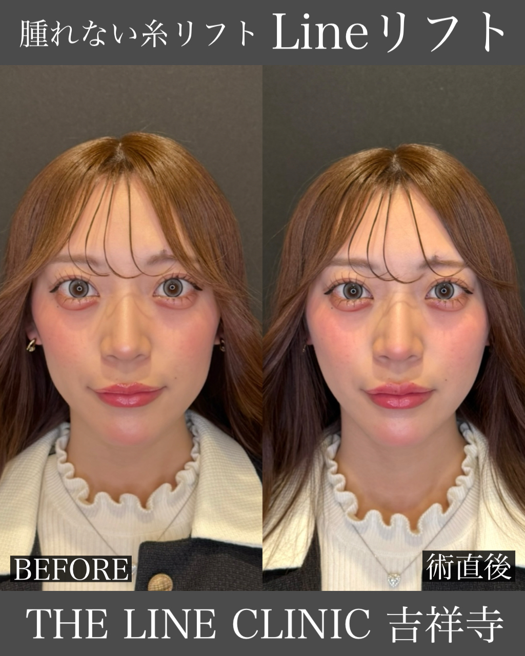 Lineリフト症例
