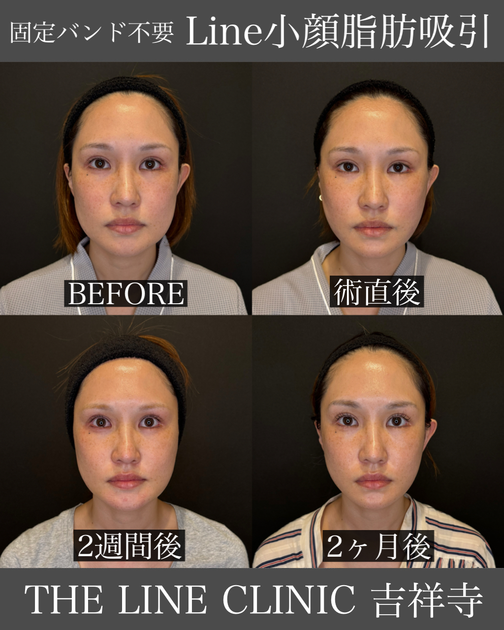 Line小顔脂肪吸引症例