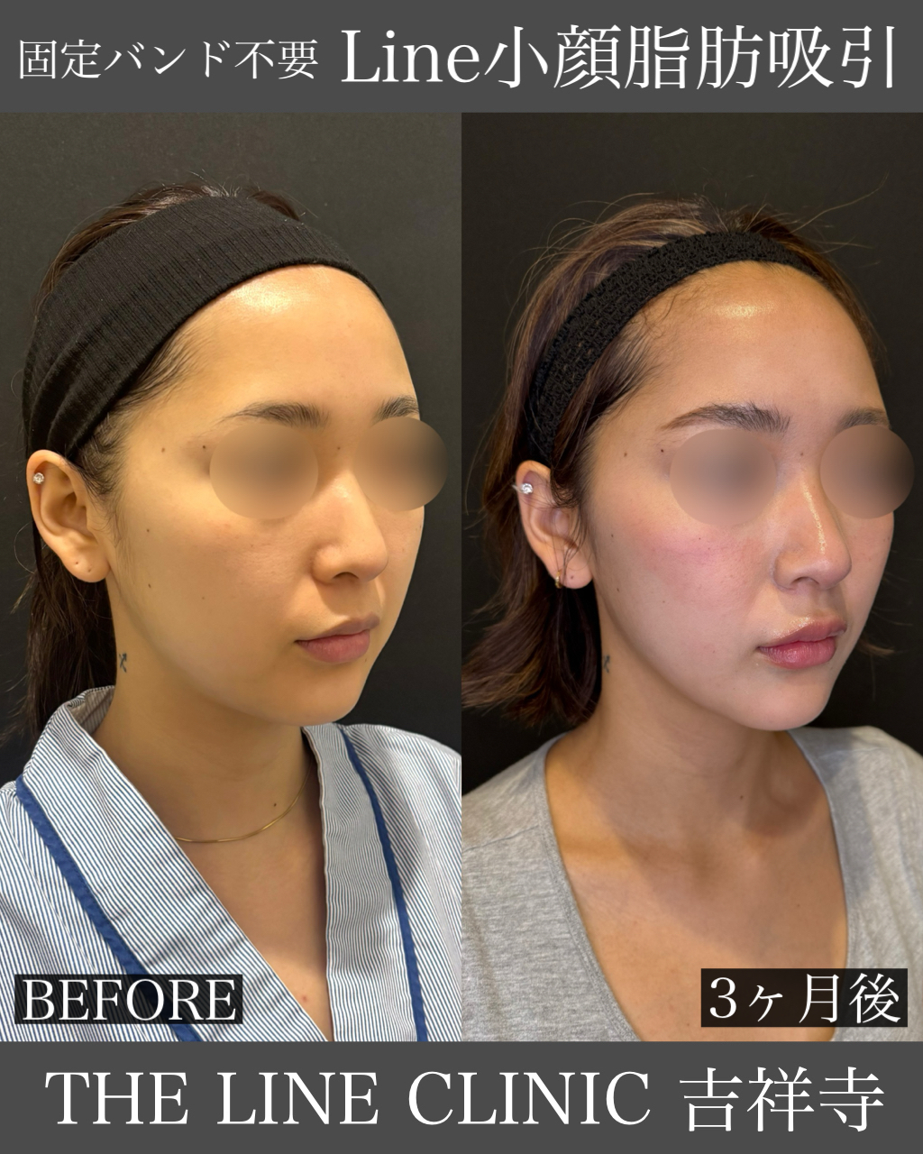 Line小顔脂肪吸引症例